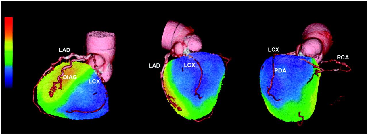 Myocardial Perfusion Imaging